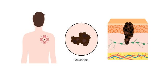 Melanoma illustration.