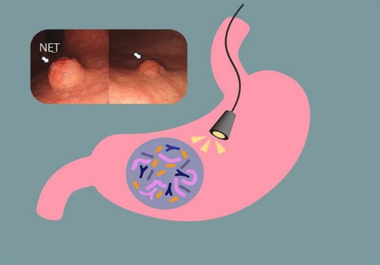 Researchers took biopsies of AIG patients with and without neuroendocrine tumor growth to understand their bacterial communities.