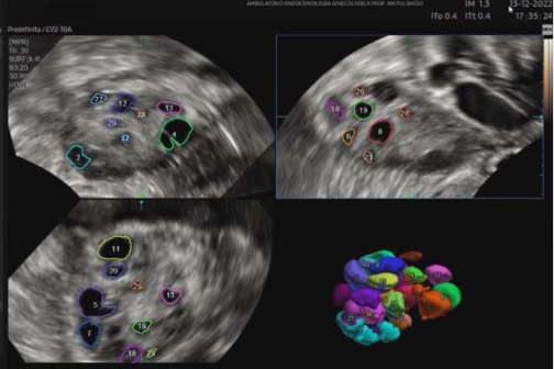 Ultrasound scans and 3D rendering of polycystic ovaries.