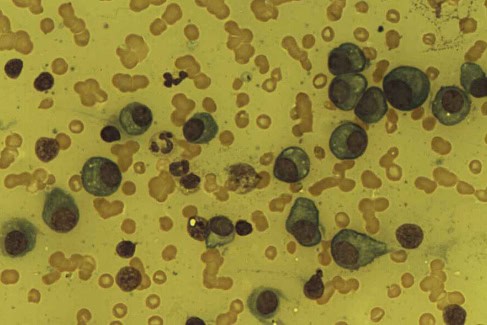 Plasma cells in multiple myeloma patient.