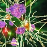 Neurons and amyloid plaques illustration.