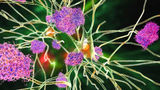 Neurons and amyloid plaques illustration.
