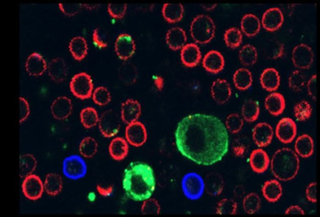 Melanoma cells (green) are shown in co-culture with the patient’s own immune cells.