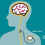 Vagus nerve stimulation for depression, illustration.