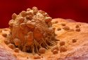 Melanoma cell illustration.