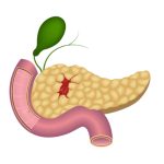 Pancreatic cancer illustration.