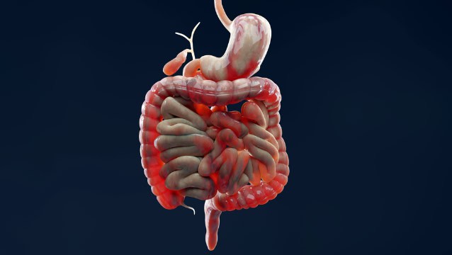 Inflamed large intestine, Crohn's disease, digestive system.
