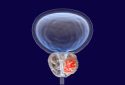Prostate cancer illustration.