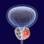 Prostate cancer illustration.