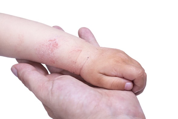 Eczema on a child's arm.