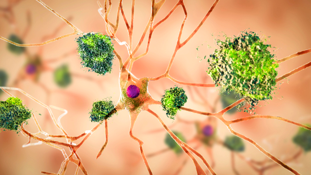 Neurons with amyloid-beta aggregates, illustration.