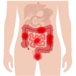 Crohn's disease concept.