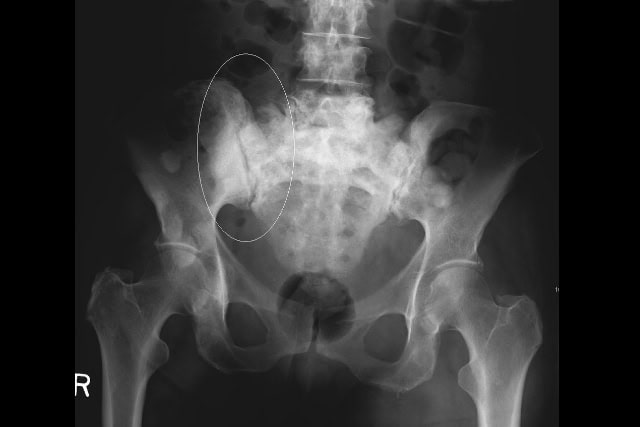 Sclerotic breast cancer metastases in the pelvis.