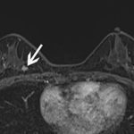 Breast cancer MRI.