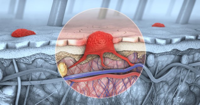 3d illustration of a cross-section of skin with melanoma (skin cancer).