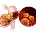 Pancreatic cancer anatomy.