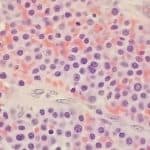 Multiple myeloma (plasmacytoma) biopsy specimen.