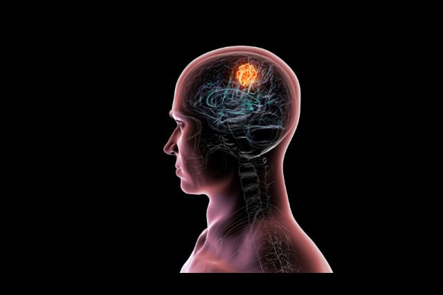 Brain tumor, brain cancer, illustration.