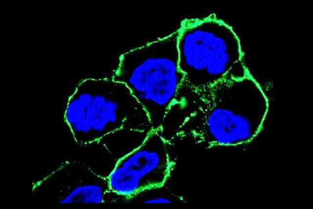 Antibody-drug conjugate (green) precisely targets fusion-driven cancer cells (blue).