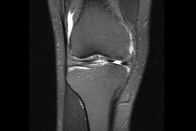 MRI image - knee with meniscus tear.