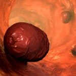 Colorectal precancerous polyps.