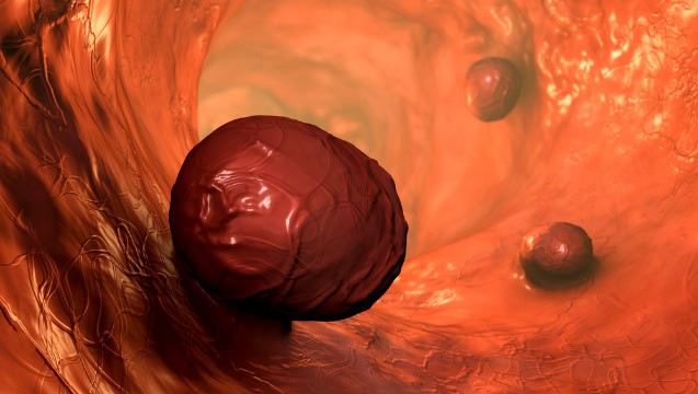 Colorectal precancerous polyps.