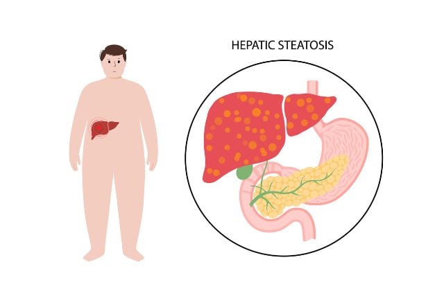Fatty liver disease illustration.