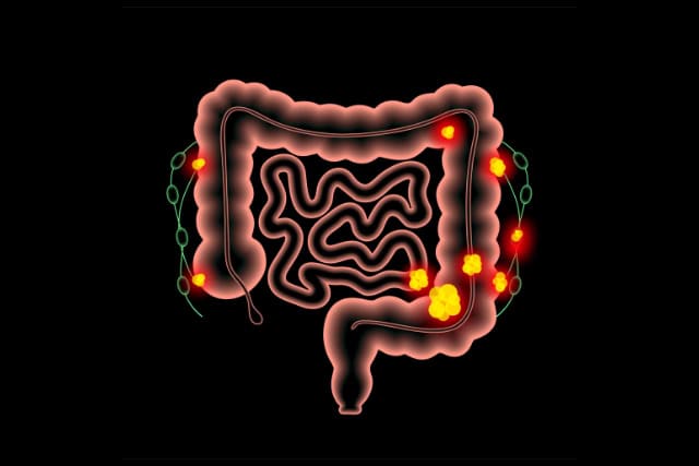 Colorectal cancer illustration.