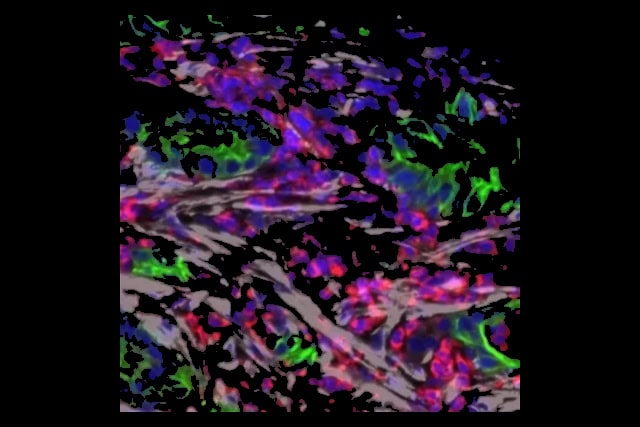 Pancreatic tumor microscopy.