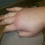 Swollen hand during a hereditary angioedema attack.