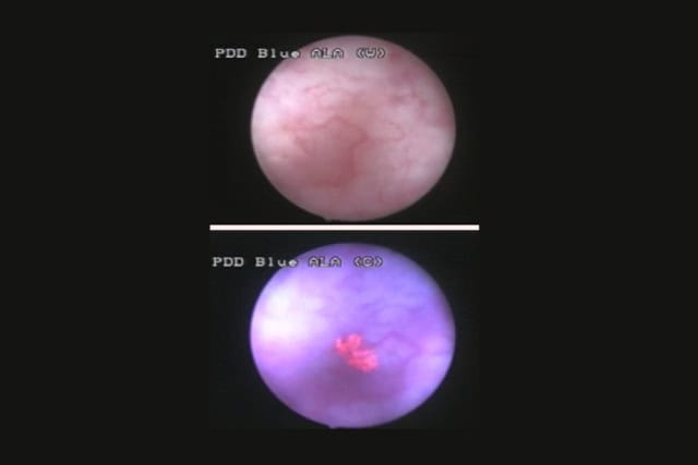 Bladder tumor detected by blue light cytoscopy.