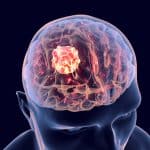 Brain cancer illustration.
