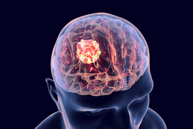 Brain cancer illustration.