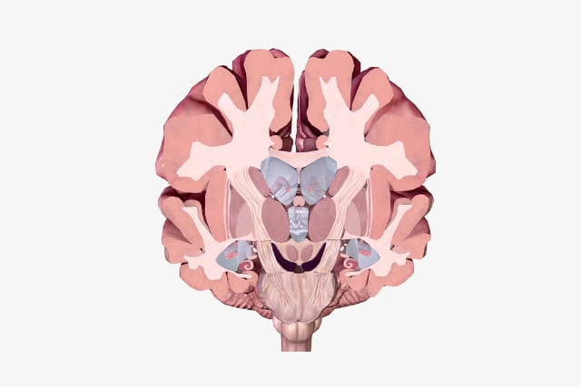 Alzheimer's disease brain cross section (illustratiion).