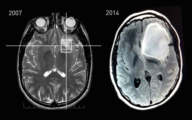 MRI scans of an astrocytoma patient.