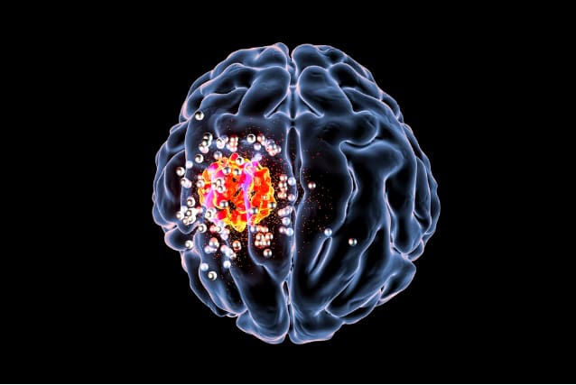 Destruction of brain tumor by nanoparticles (illustration).