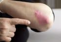 Psoriasis on elbow.