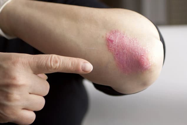 Psoriasis on elbow.