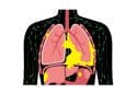 Mesothelioma, lung cancer illustration.
