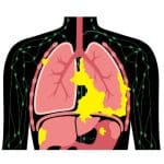 Mesothelioma, lung cancer illustration.