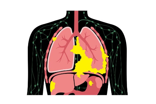 Mesothelioma, lung cancer illustration.
