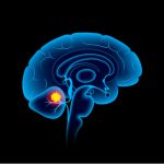 Medulloblastoma brain tumor illustration.