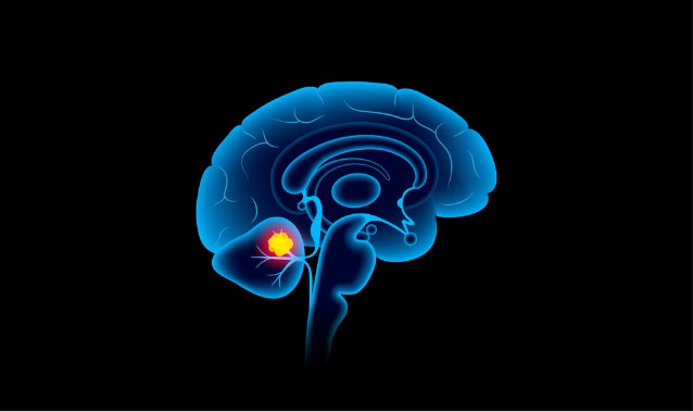 Medulloblastoma brain tumor illustration.