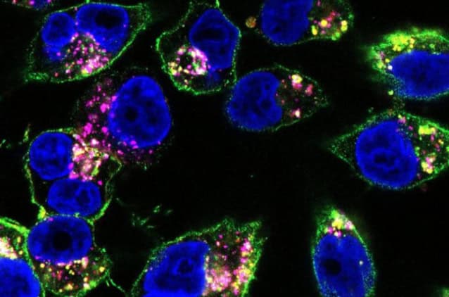 Pancreatic cancer cells.