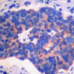 Small cell lung carcinoma, chromogranin immunostain.