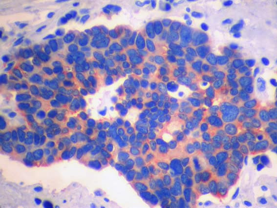 Small cell lung carcinoma, chromogranin immunostain.