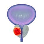Prostate cancer, illustration.