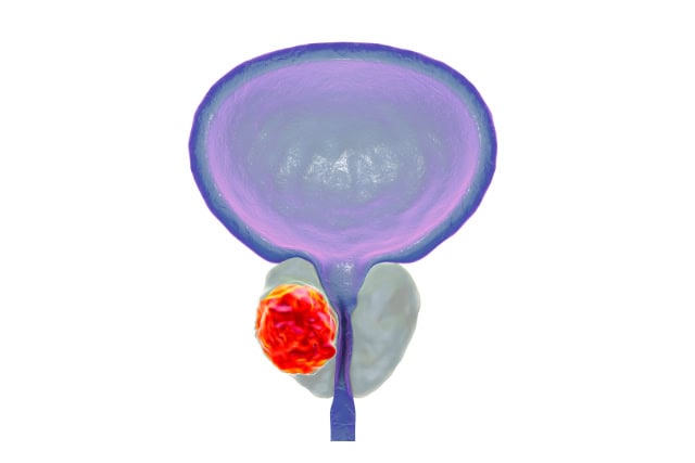 Prostate cancer, illustration.