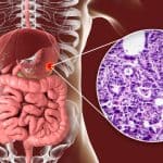 Stomach adenocarcinoma, gastric cancer, illustration.