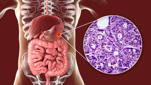 Stomach adenocarcinoma, gastric cancer, illustration.